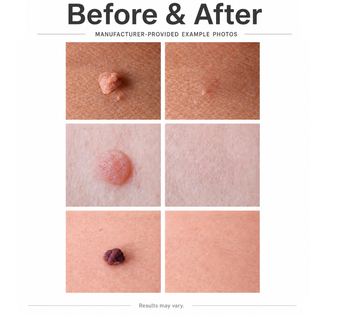 TagSmooth™ Skin Tag Removal Kit
