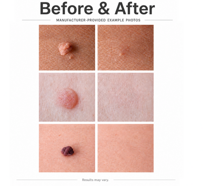 TagSmooth™ Skin Tag Removal Kit